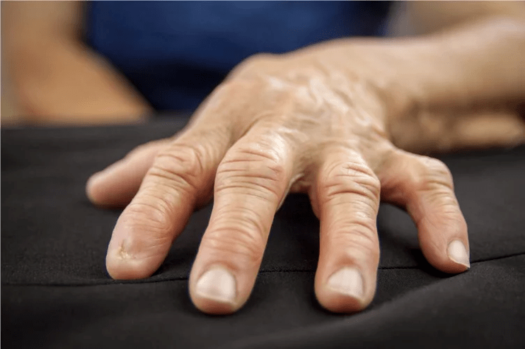 With gout, the knuckles of the fingers become hot to the touch, swollen, and painful. 