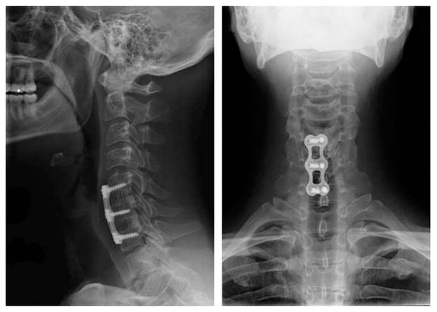 image after the treatment of the vertebrae