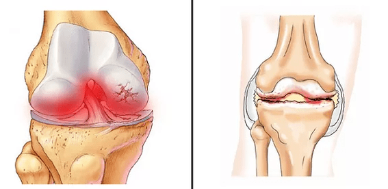 Comparison of arthritis arthrosis