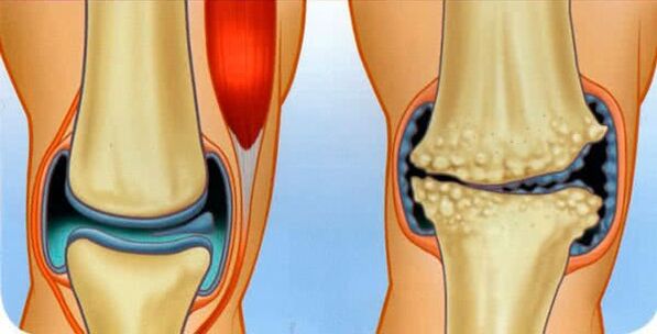 healthy joint and joint arthrosis