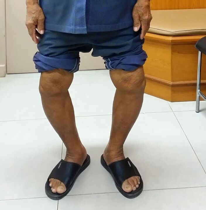 deformed knee joints with osteoarthritis