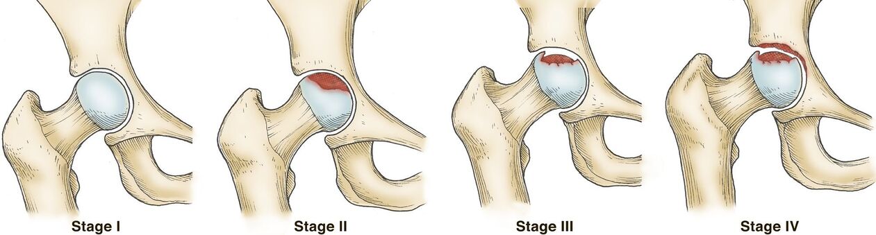 Degrees of osteoarthritis of the hip joint