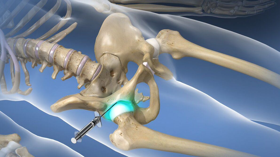 Intra-articular block for the intense pain accompanying hip osteoarthritis