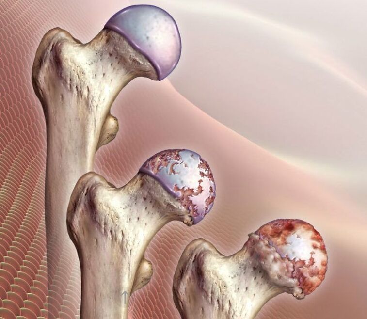 Osteoarthritis of the hip joint of varying degrees