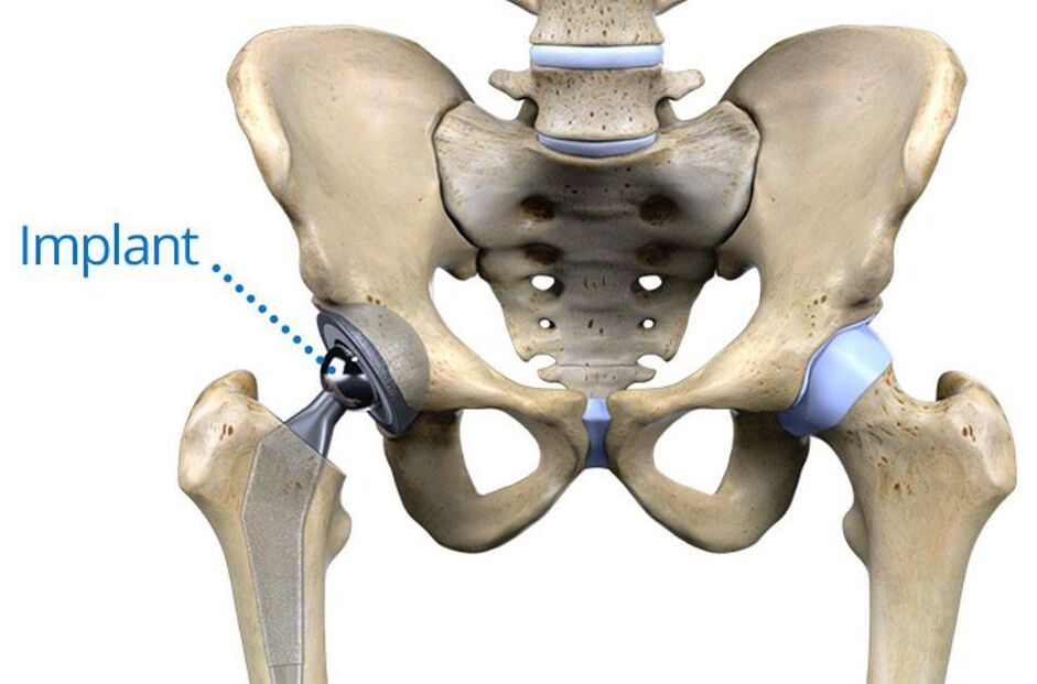 Total hip arthroplasty for osteoarthritis